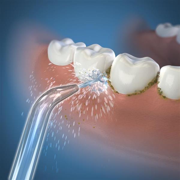 Waterpik® Classic High-Pressure Jet Tip